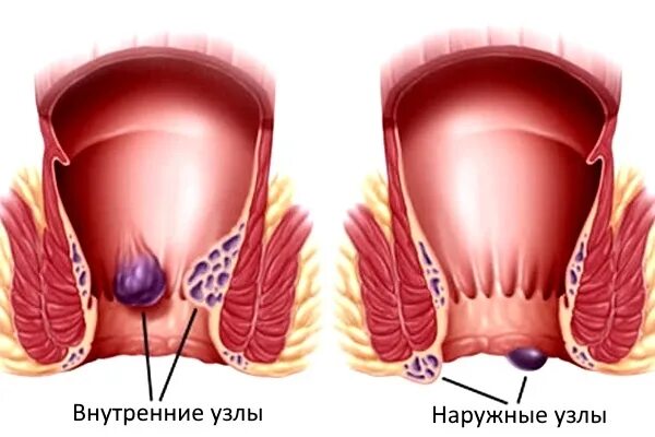 Показать фото как выглядит геморрой Геморроидальный тромбоз: лечение наружного и внутреннего геморроидального узла -