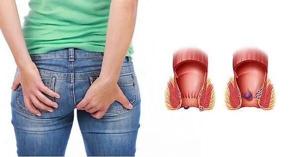 Показать фото как выглядит геморрой How to deal with hemorrhoids at home, symptoms & causes - Album on Imgur