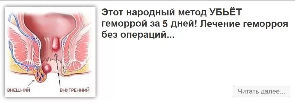 Показать фото как выглядит геморрой Схема лечения наружного геморроя у мужчин