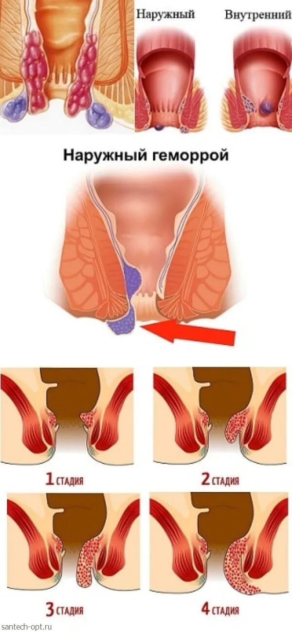 Показать фото как выглядит геморрой Геморрой клиническая картина