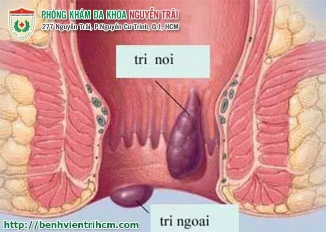 Показать фото как выглядит геморрой Sưng hậu môn và đau đó là tình trạng có thể gặp ở bất kỳ đối tượng nào không phâ