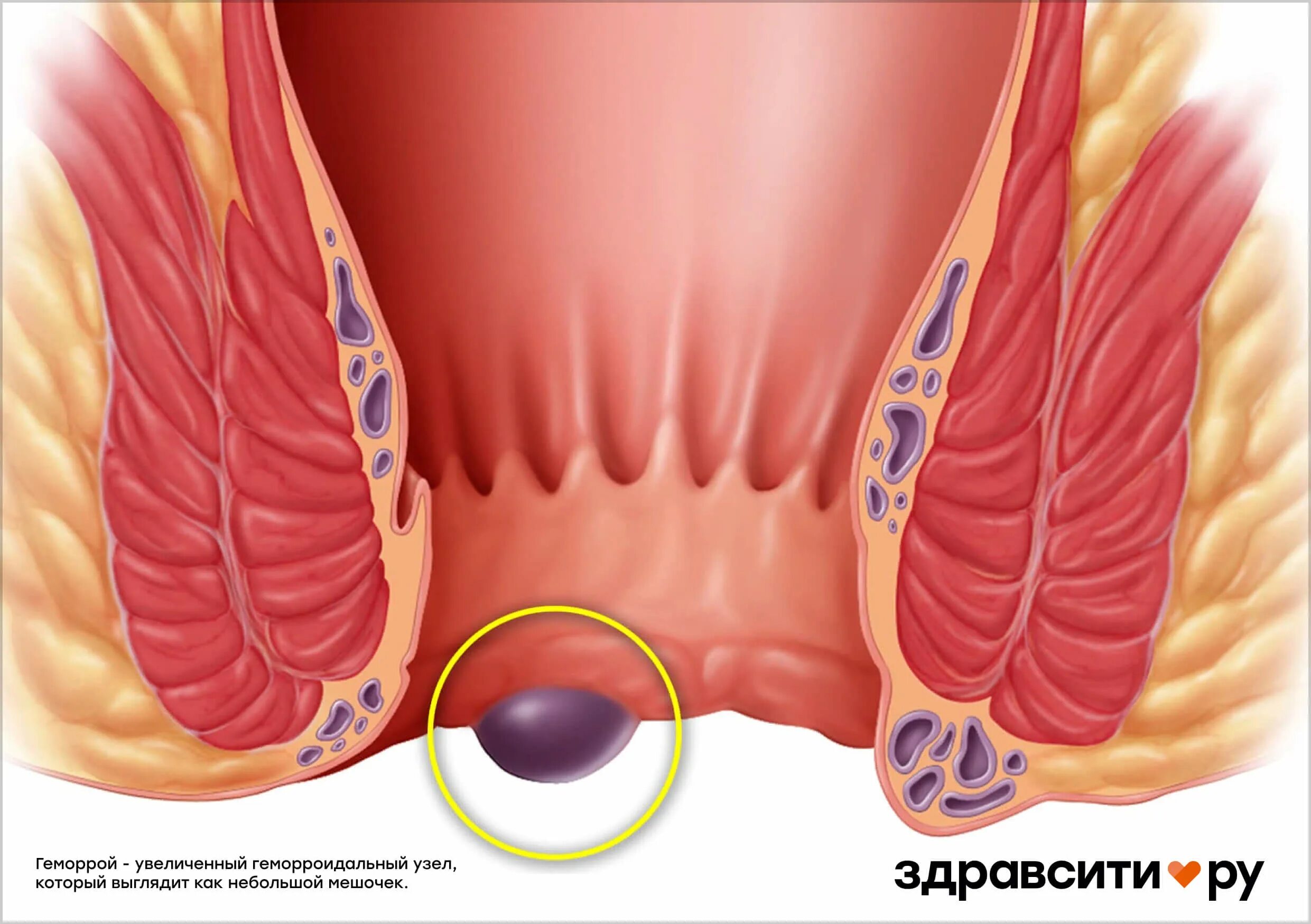 Показать фото как выглядит геморрой 7 причин геморроя