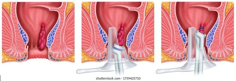 Показать фото как выглядит геморрой 3 112 рез. по запросу "Open elastic" - изображения, стоковые фотографии, трехмер