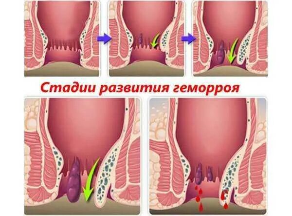 Показать фото как выглядит геморрой Стадии геморроя схема