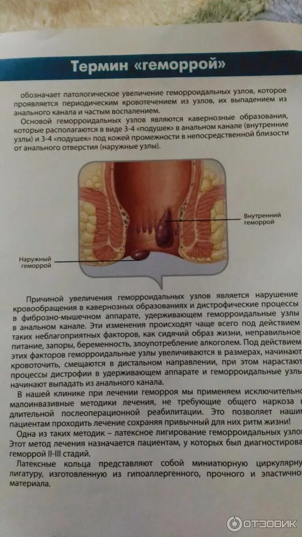 Показать фото как выглядит геморрой Отзыв о Вакуумное лигирование геморроидальных узлов Лечение геморроя без операци