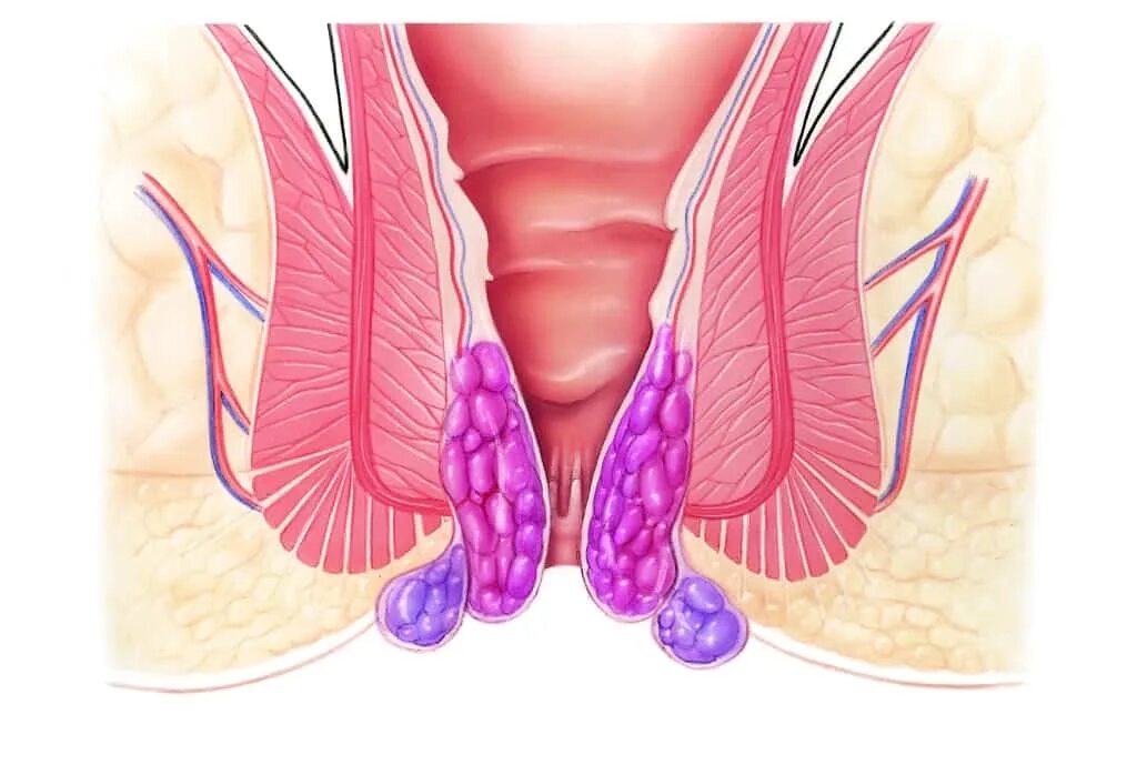 Показать фото как выглядит геморрой Наружный геморрой - лечение внешних геморроидальных узлов