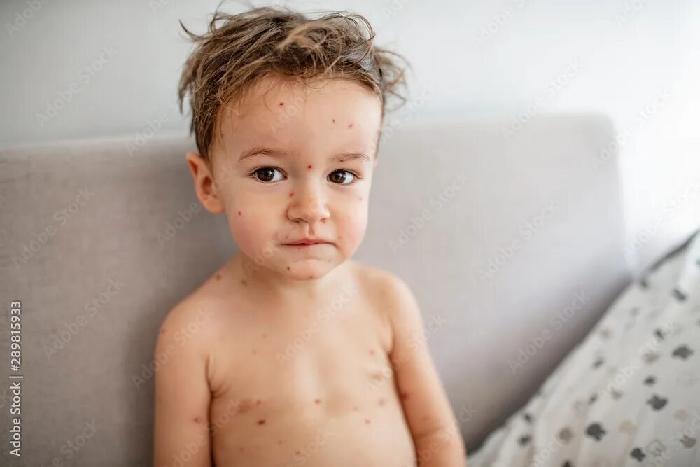 Показать фото как выглядит ветрянка Closeup of cute little boy. Varicella virus or Chickenpox bubble rash on child. 