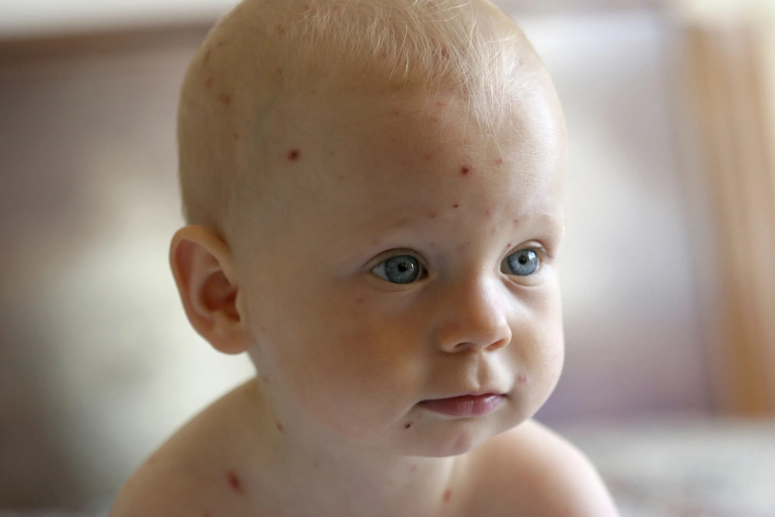 Показать фото как выглядит ветрянка More than half of chickenpox diagnoses are wrong, study finds Ars Technica