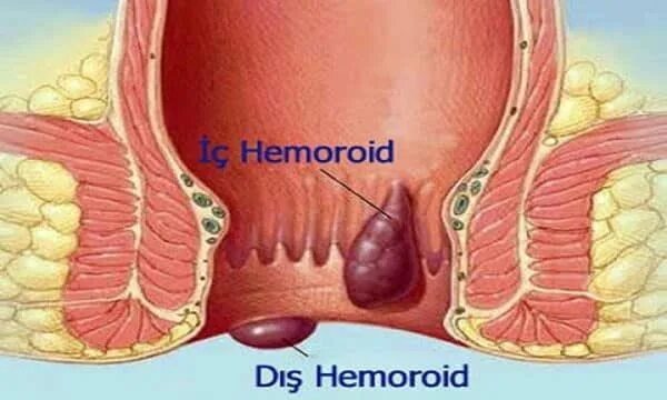 Показать как выглядит геморрой Hemoroid (Basur) Nedir? Belirtileri, Nedenleri ve Hemoroid Tedavisi Doktorlar ve