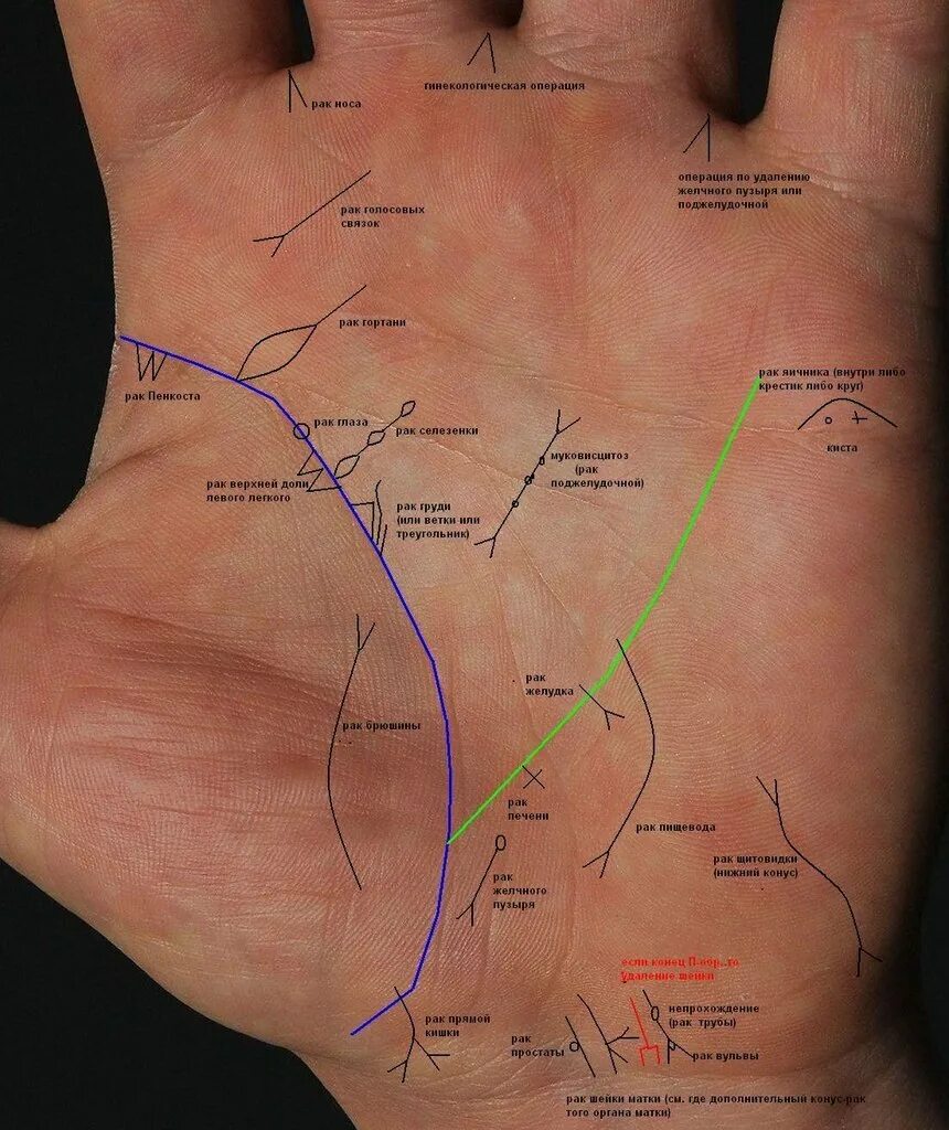 Показать линию жизни на руке фото ВОПРОСЫ о Знаках и Линиях на Ваших Руках (ПРОЧТИТЕ ПЕРВОЕ СООБЩЕНИЕ ТЕМЫ, несоот