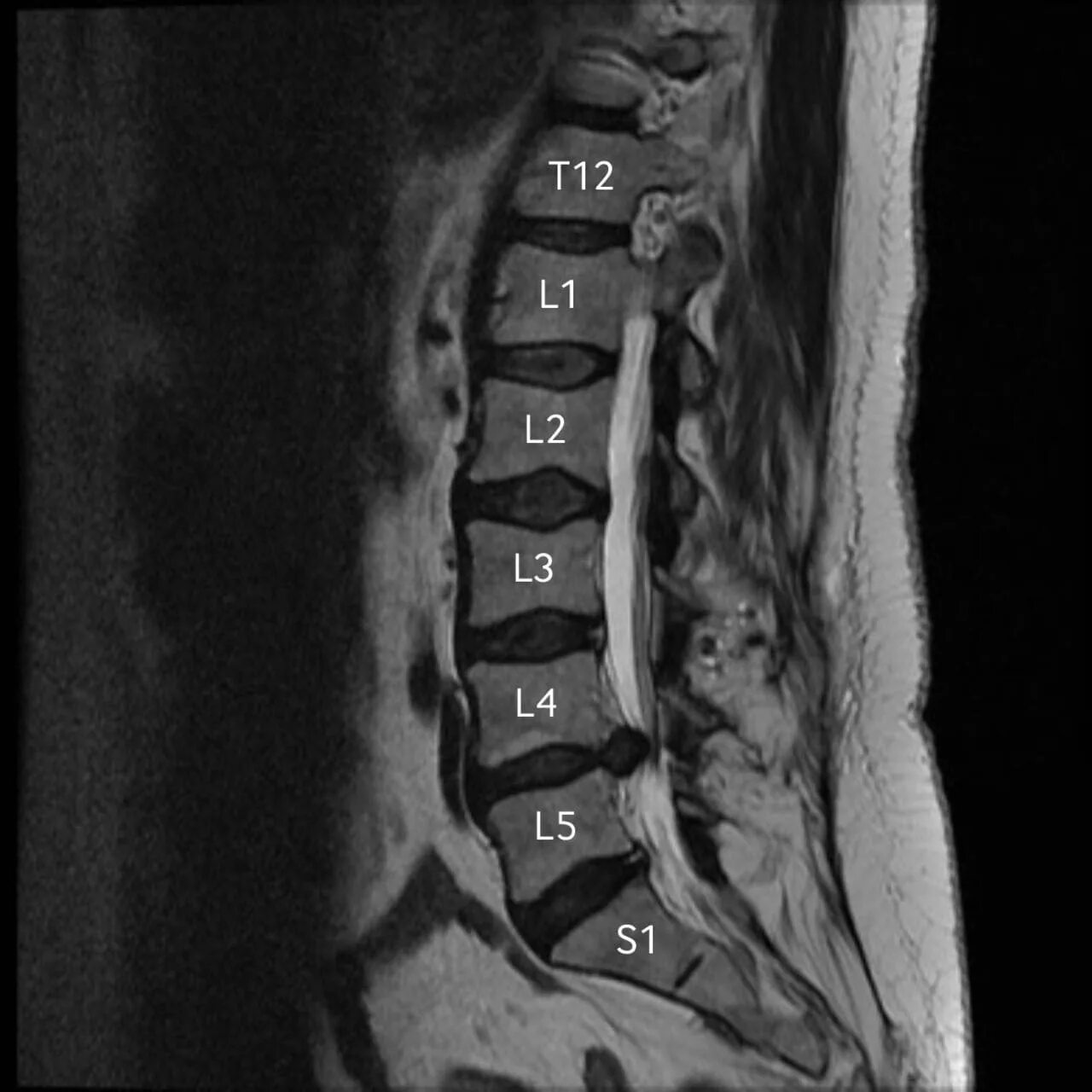Показать пояснично крестцовый отдел позвоночника фото МРТ при болях в пояснице - томография позвоночника с бесплатной консультацией не