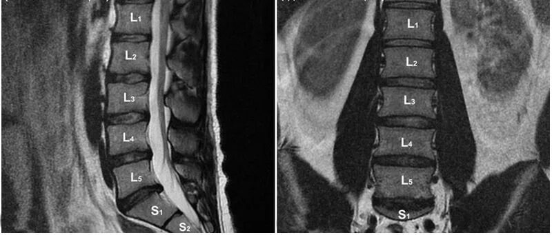 Показать пояснично крестцовый отдел позвоночника фото Заключение МРТ пояснично-крестцового отдела позвоночника - VSEMRT