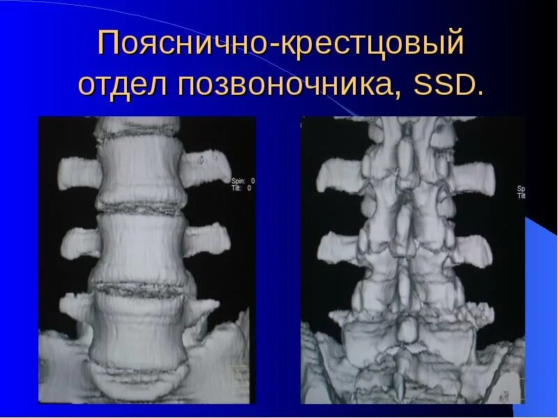 Показать пояснично крестцовый отдел позвоночника фото Пояснично крестцовый отдел позвонки