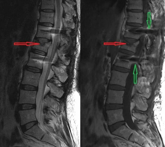 Показать поясничный отдел позвоночника фото МРТ позвоночника: что показывает и когда назначается. КТ или МРТ спины лучше