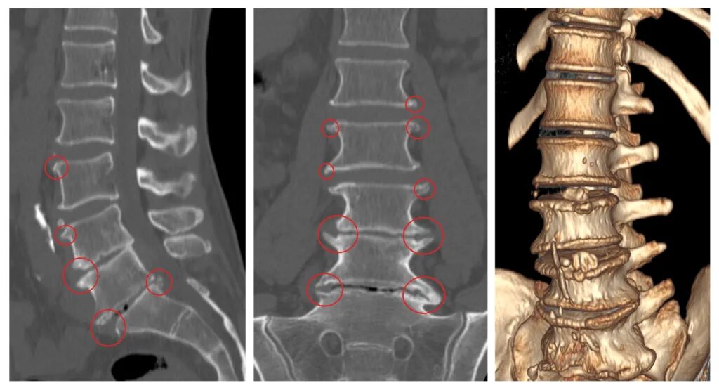 Показать поясничный отдел позвоночника фото Смещение дисков