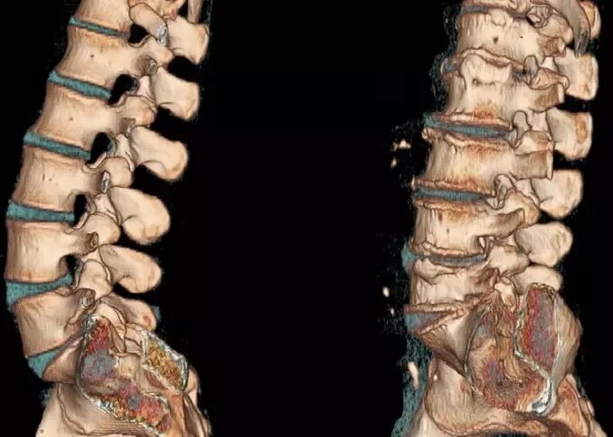 Показать поясничный отдел позвоночника на человеке фото Что покажет КТ поясничного отдел, особенности и преимущества компьютерной томогр