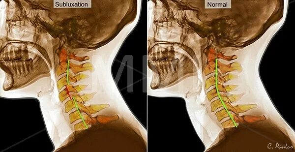 Показать шейный отдел позвоночника фото Color X Rays Cervical Spine Subluxation Before After Anatomie, Inka