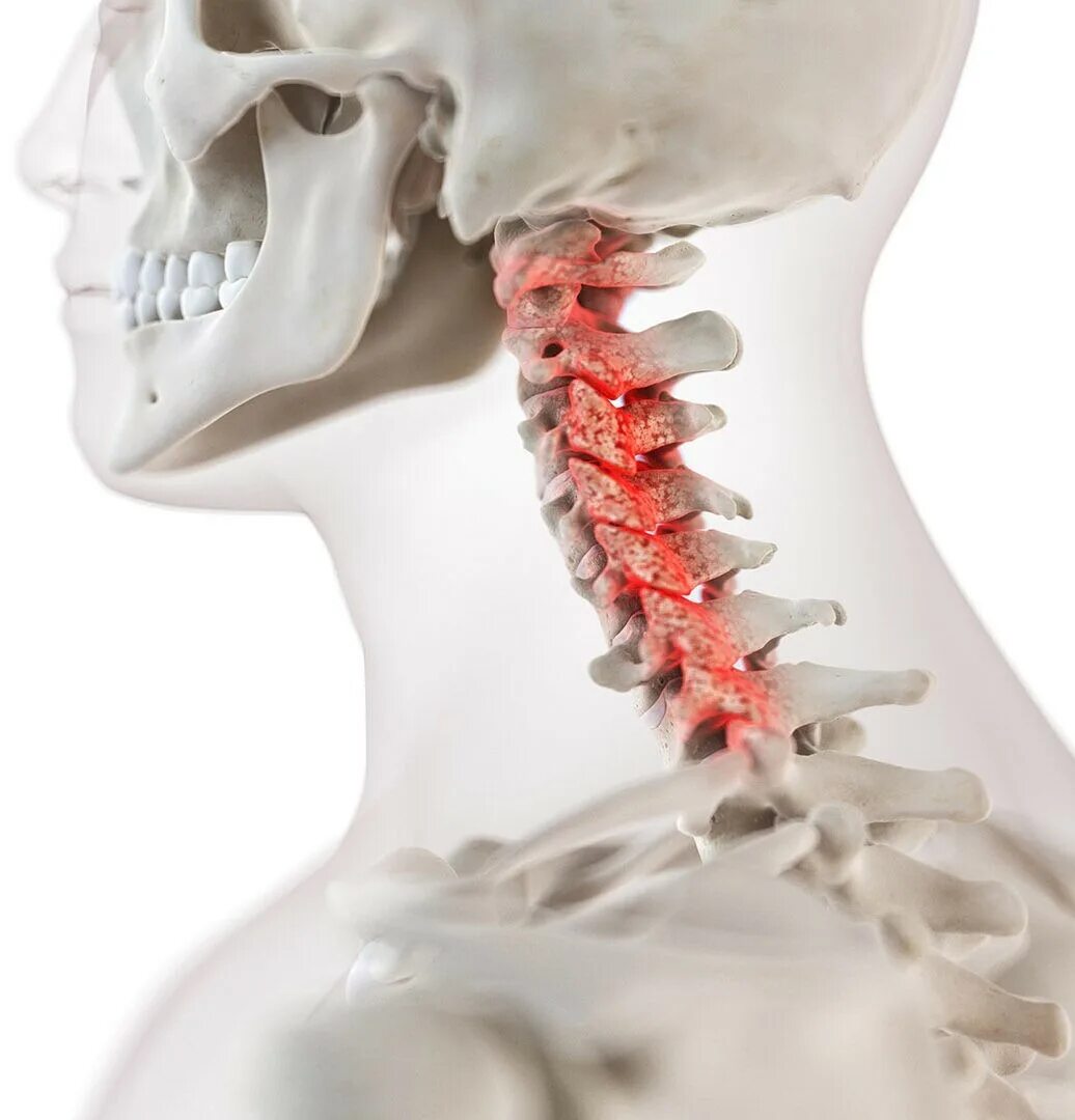Показать шейный отдел позвоночника фото Лечение грыжи шейного отдела позвоночника - в Ростове-на-Дону