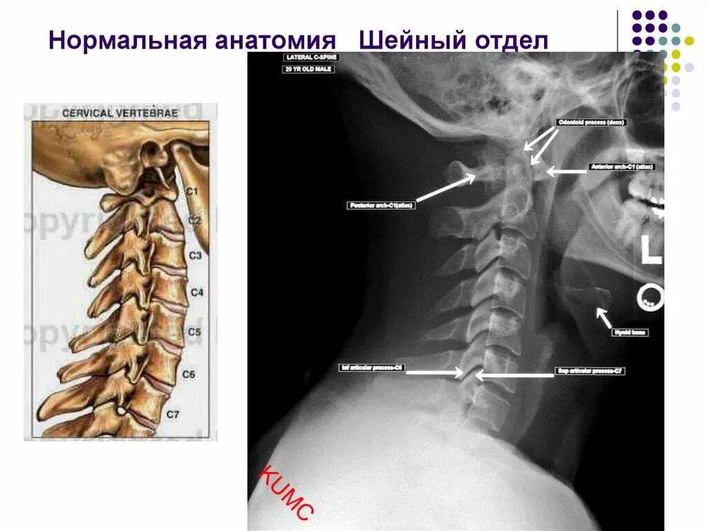 Показать шейный отдел позвоночника фото В шейном отделе позвоночника всегда 5 позвонков