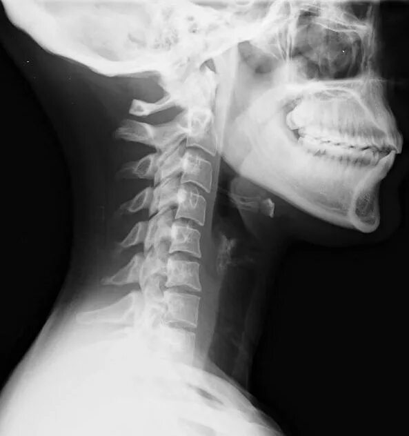 Показать шейный отдел позвоночника фото File:Lateral neck X-ray of whiplash.jpg - Wikipedia