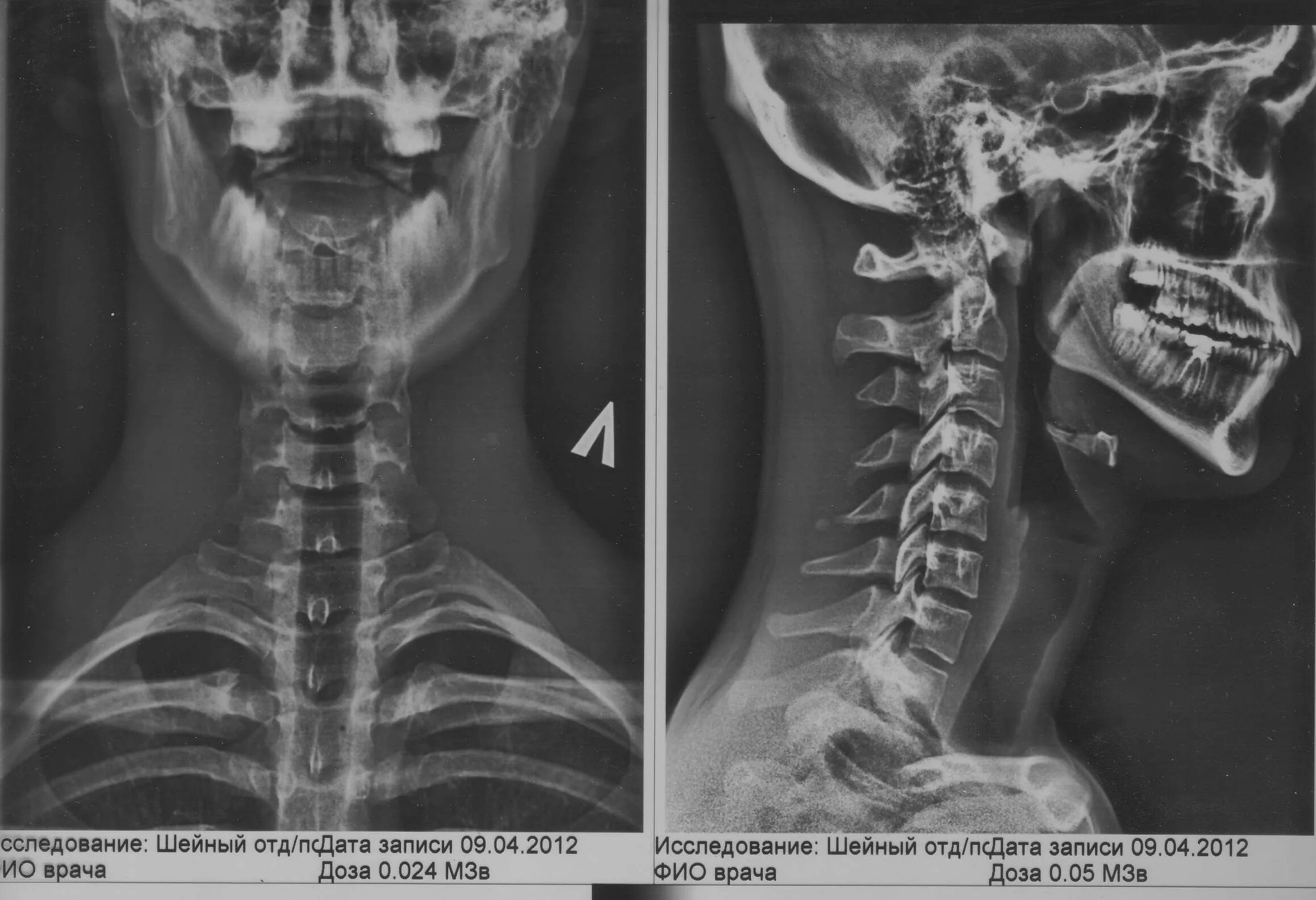 Показать шейный отдел позвоночника фото Исследование шейного отдела позвоночника Портал радиологов