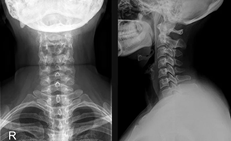 Показать шейный отдел позвоночника фото Рентгенография позвоночника