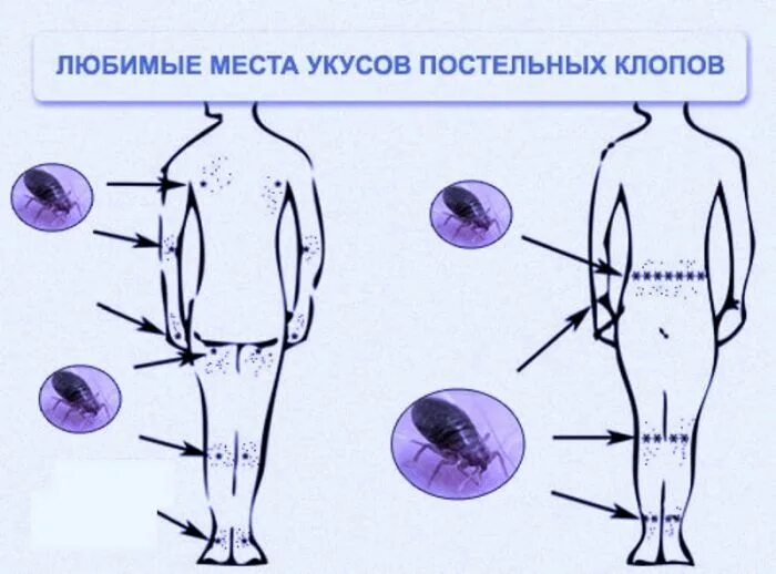 Показать укусы клопов на теле человека фото Клопы, тараканы, препаратами без запаха, бесплатная консультация - Дезинфекция п