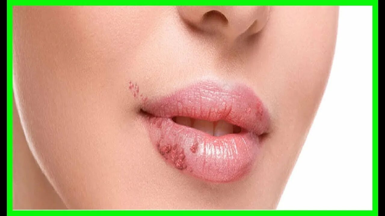 Покажи фото герпеса Remedios Caseros para Acabar con los Herpes Labiales - YouTube