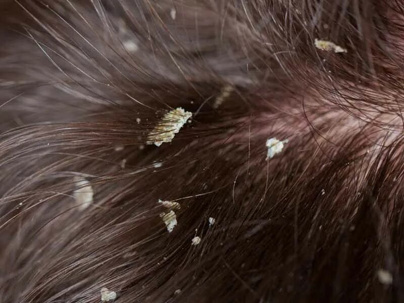 Покажи фото как выглядят вши Scalp Build Up: Don’t Mistake It For Dandruff! - Lewigs