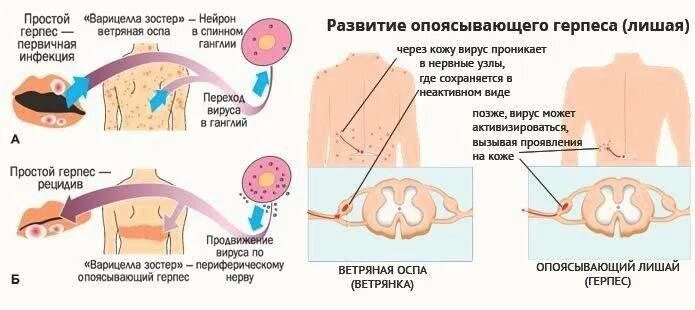 Покажи фото опоясывающего герпеса Симптомы опоясывающего лишая у детей, диагностика и схема лечения вируса герпеса