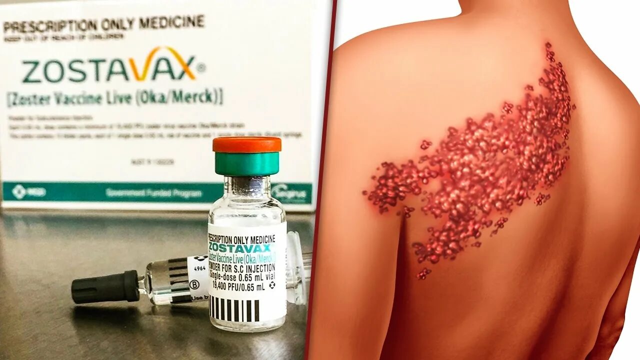 Покажи фото опоясывающего герпеса Shingles Vaccine Zostavax Is Causing What It's Designed To Prevent - The Ring Of