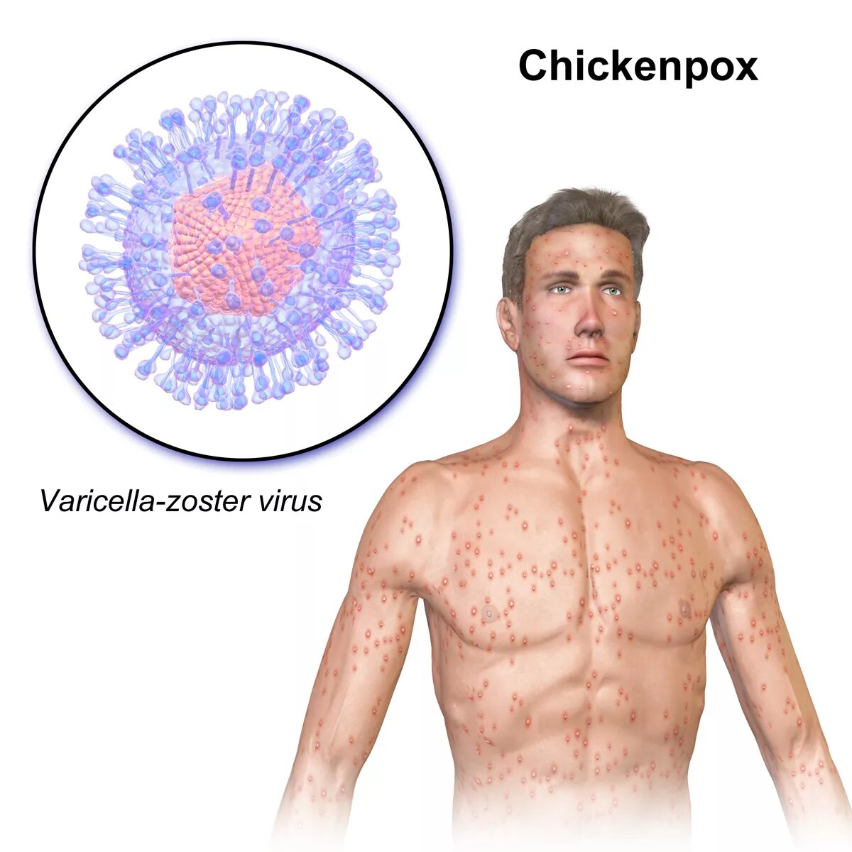 Покажи фото опоясывающего герпеса File:Chickenpox.png - Wikipedia