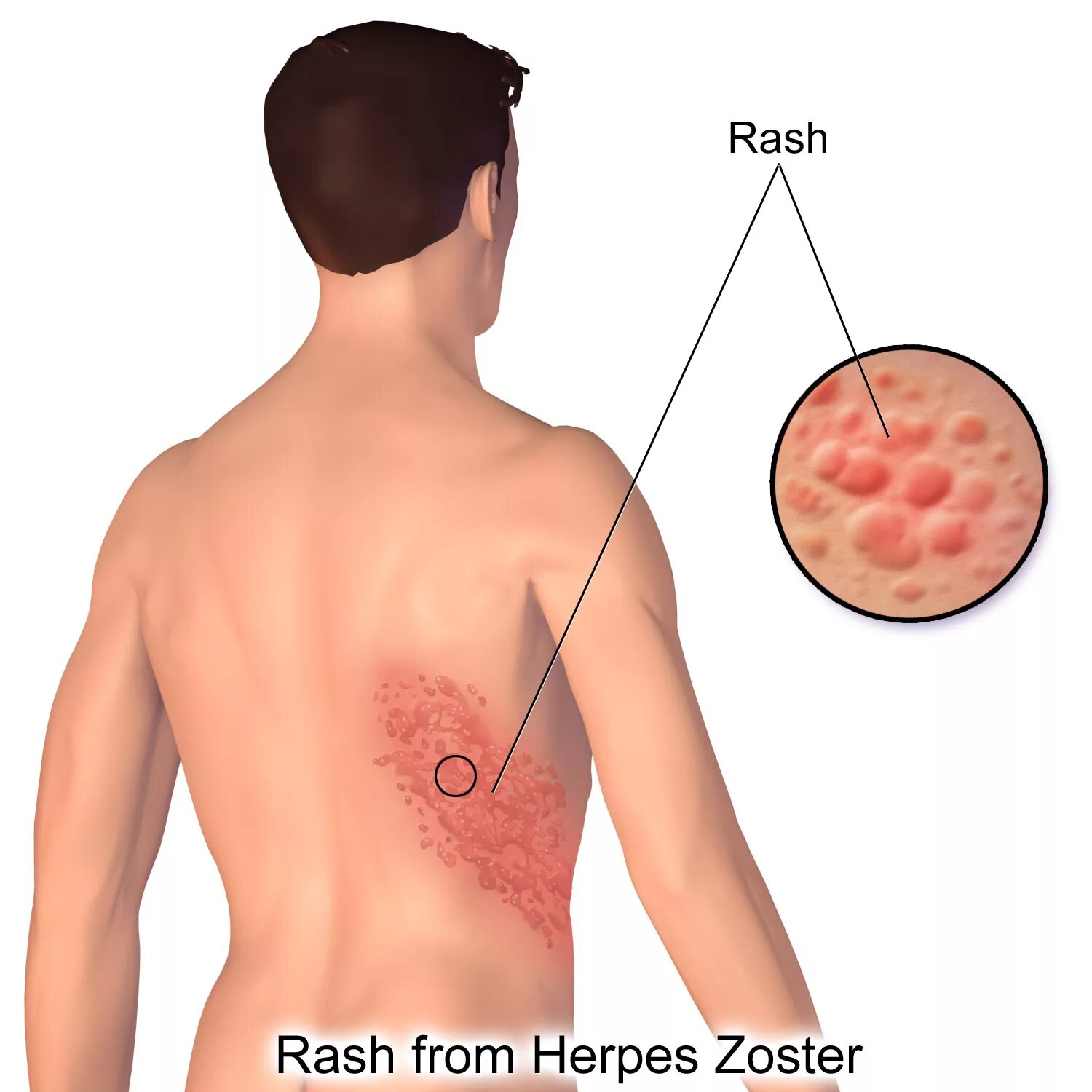 Покажи фото опоясывающего герпеса File:Herpes Zoster Rash.png - Wikimedia Commons