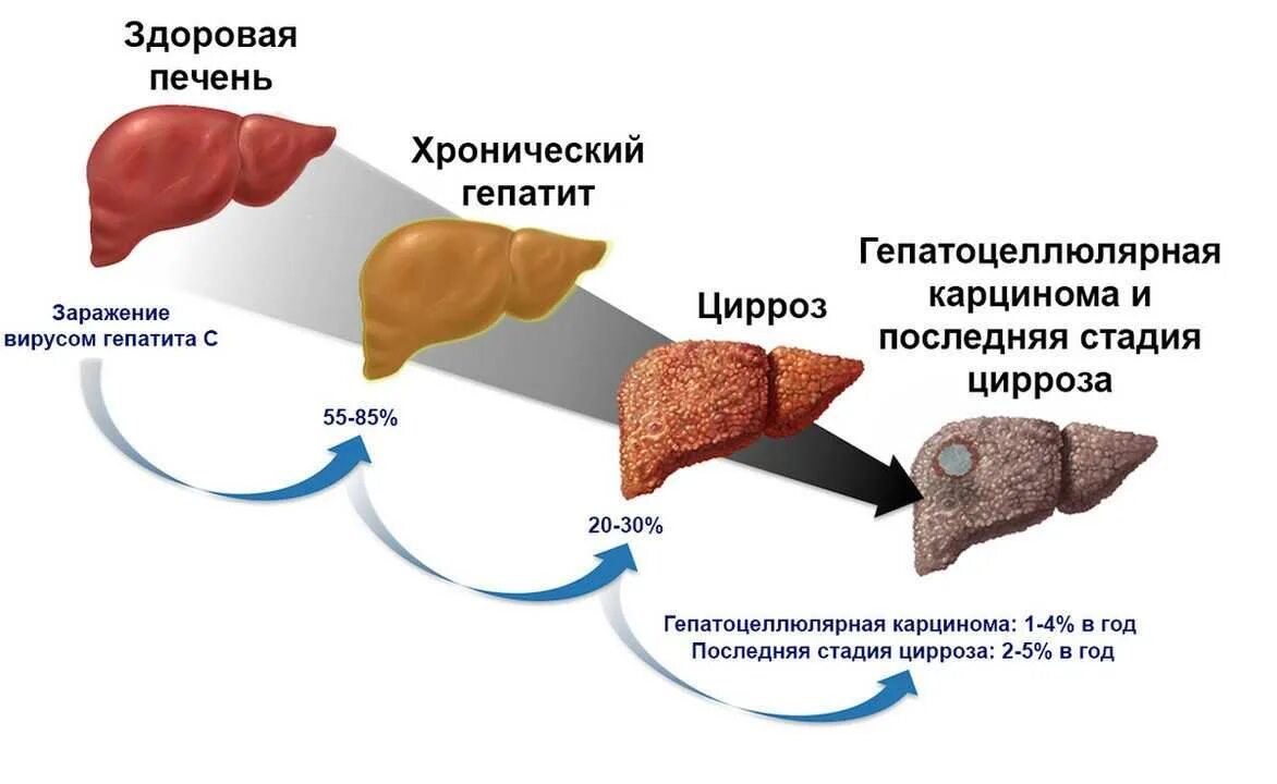 Покажи фото цирроза печени Комитет по физической культуре и спорту Тверской области