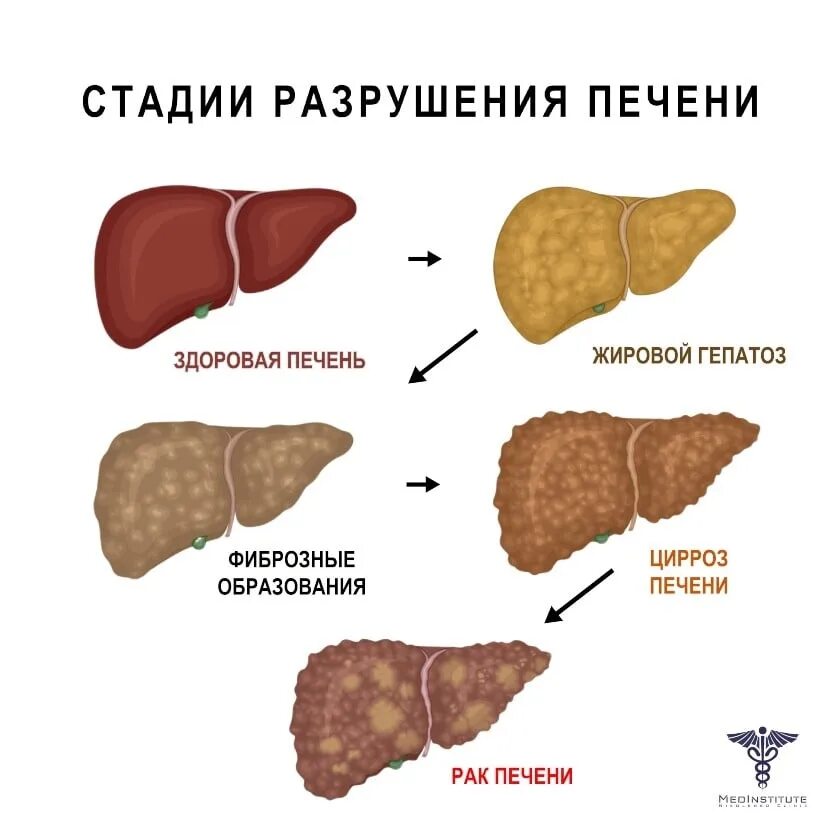 Покажи фото цирроза печени Рекомендации для населения по профилактике вирусного гепатита С