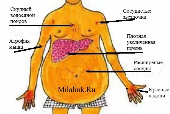 Покажи фото цирроза печени Первые симптомы цирроза печени