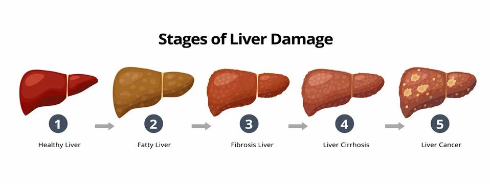 Покажи фото цирроза печени Liver Cirrhosis Зображення - огляд 15,816 Стокові фото, векторні зображення й ві