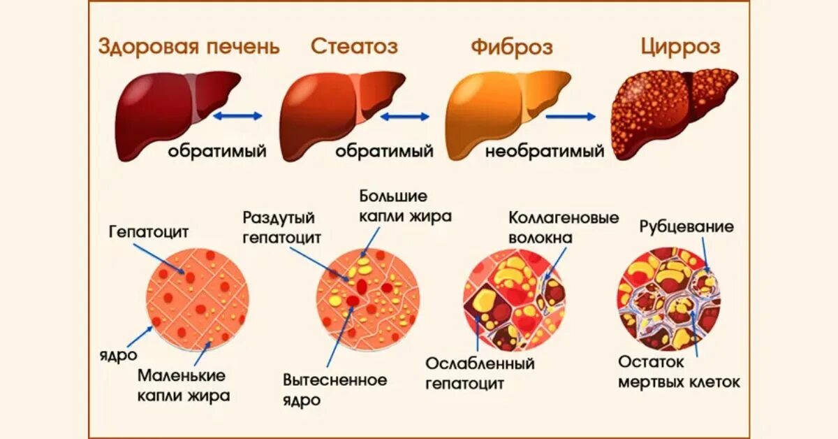 Покажи фото цирроза печени Стадии фиброза