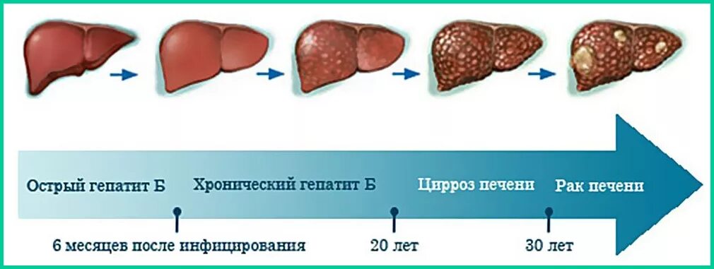 Покажи фото цирроза печени Рак печени клинические