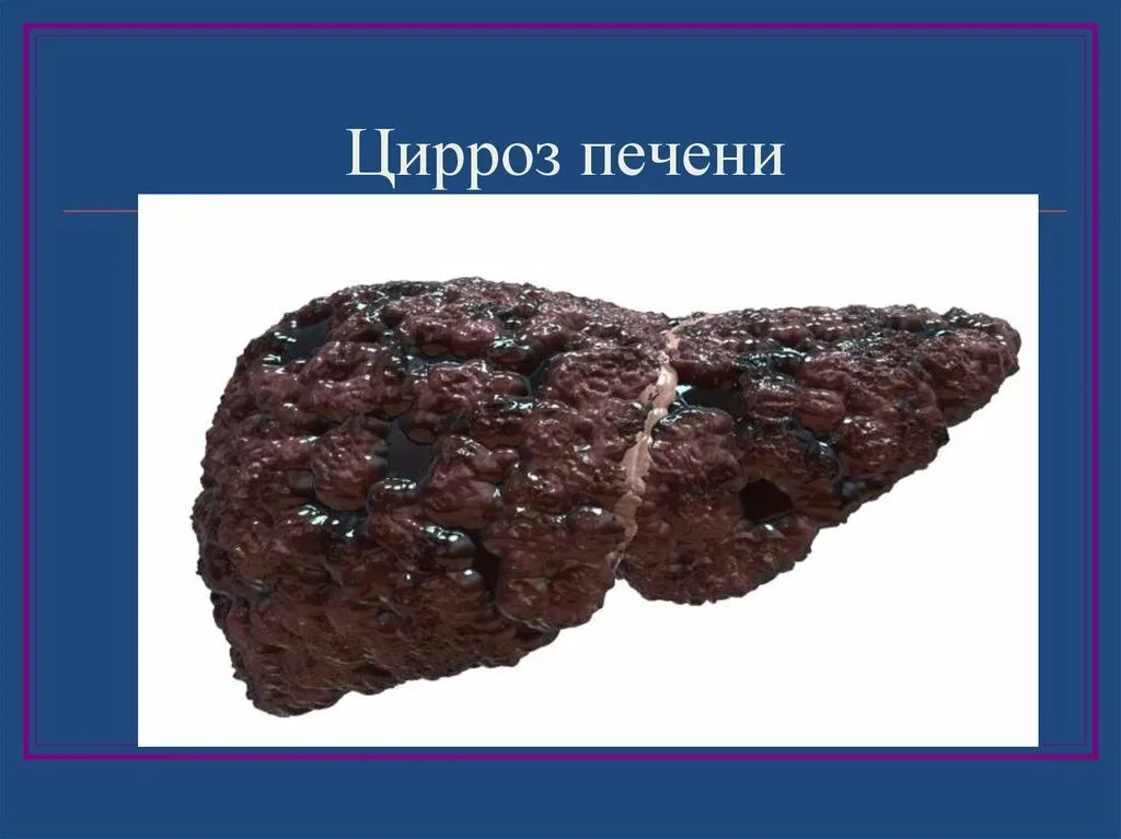 Покажи фото цирроза печени Почему развивается цирроз печени: роль жиров, влияние алкоголя, гепатита и други