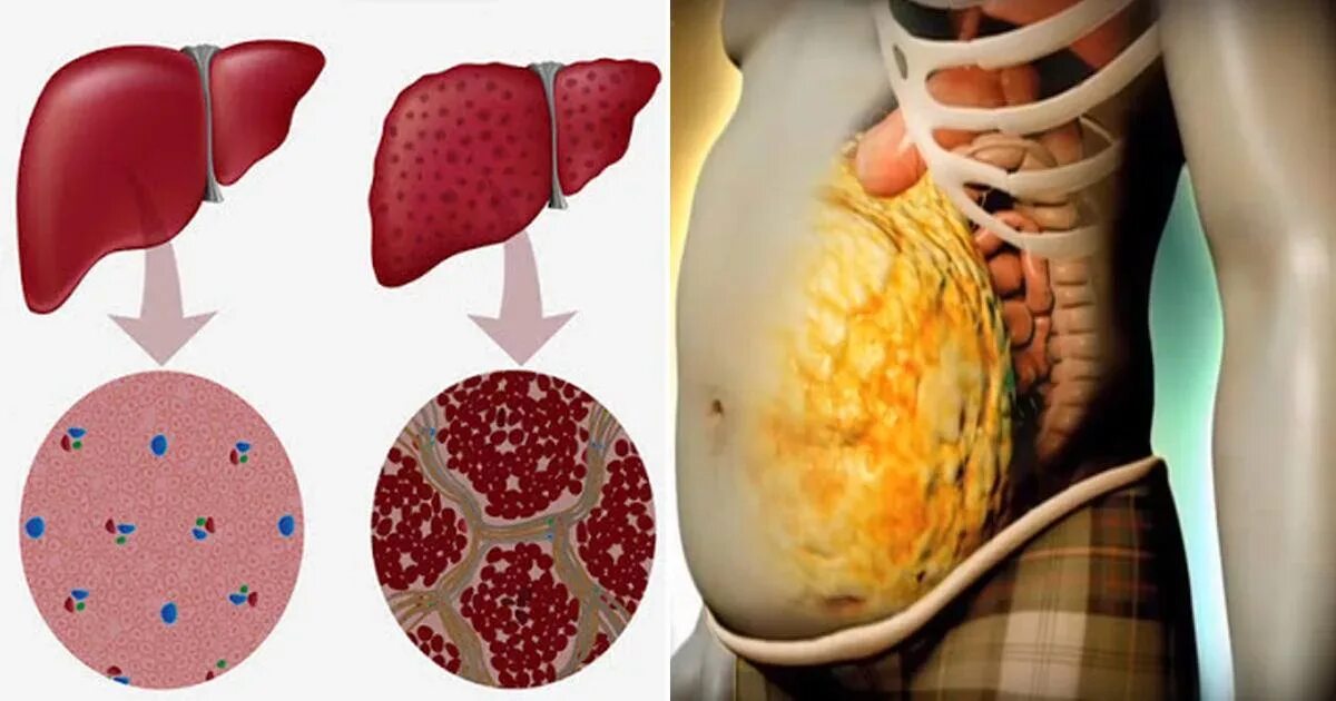 Покажи фото цирроза печени Почему развивается цирроз печени: далеко не всегда проблема только в алкоголе О 