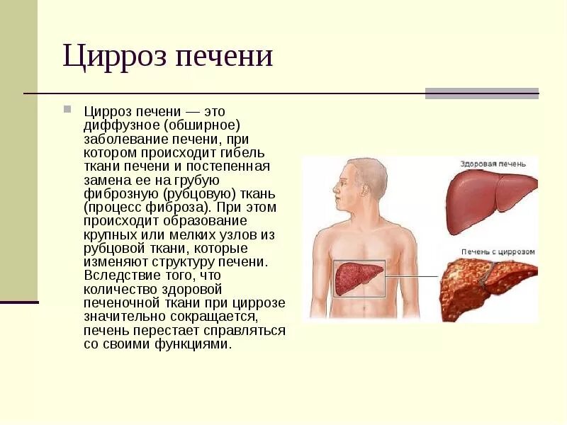 Покажи фото цирроза печени Цирроз печени