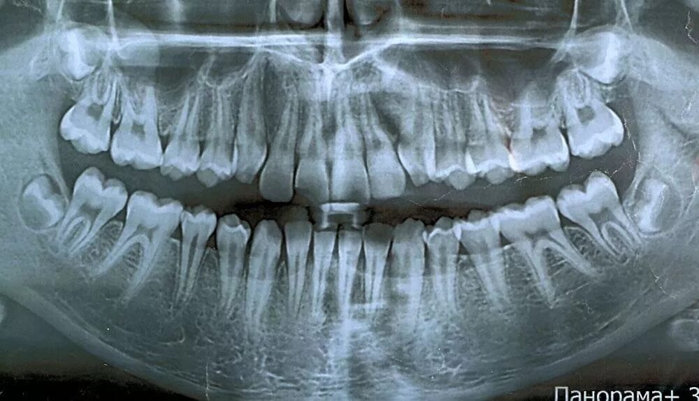 Покажи фото зубов Рентген зуба. Сделать рентгеновский снимок зубов в Москве НоваДент