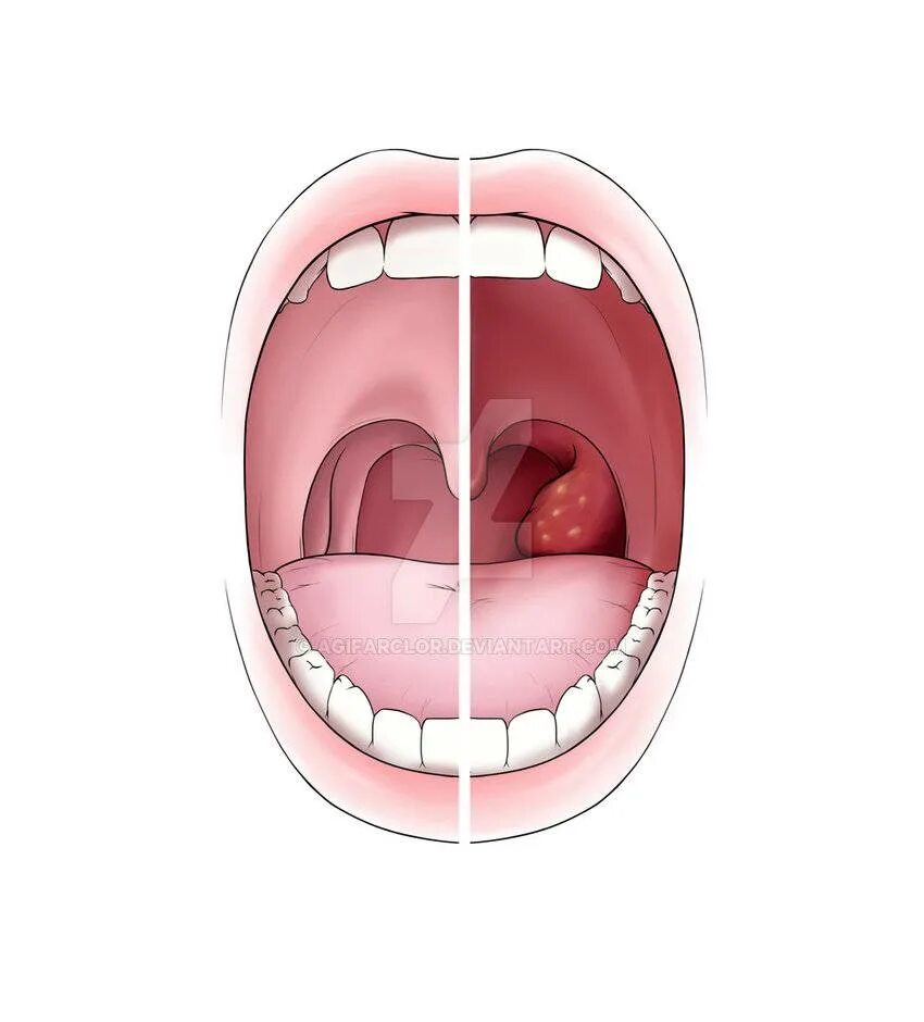 Покажи как выглядит горло Увеличение глоточной миндалины