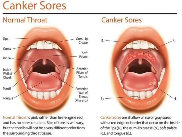 Tonsillitis - Symptoms & causes - Mayo Clinic