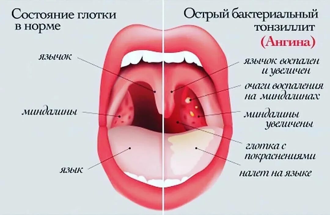 Покажи как выглядит горло Почему может болеть горло? - Медицинский центр "Добрый Доктор"