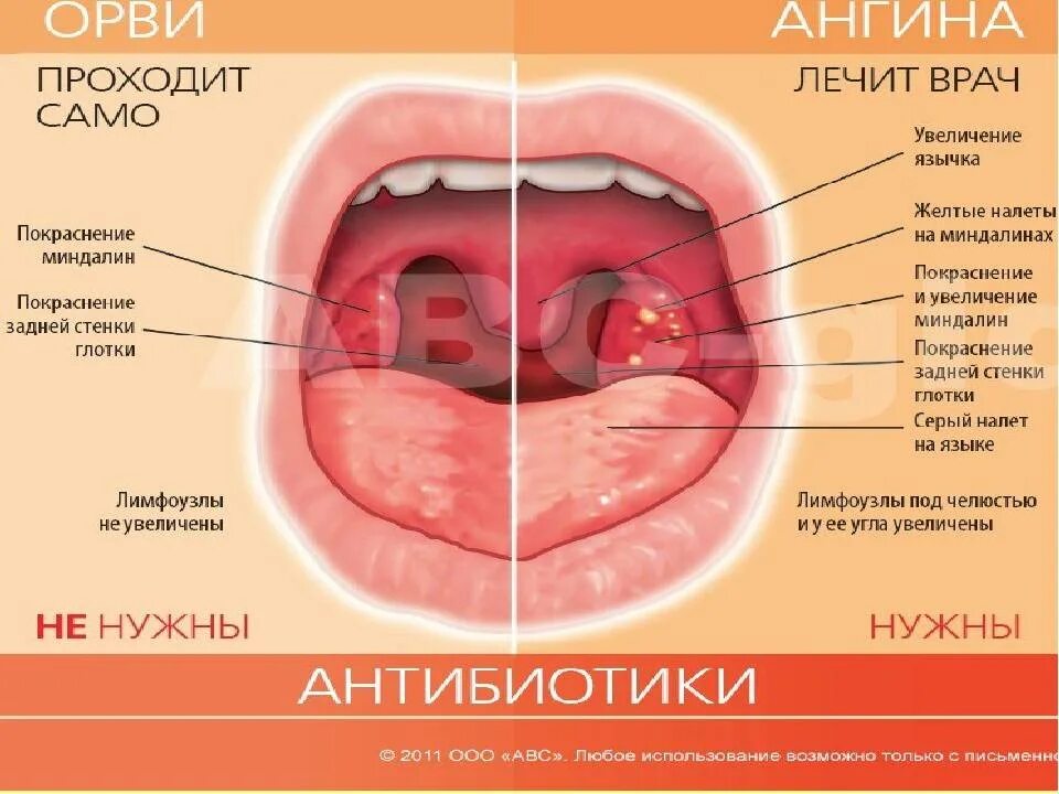 Покажи как выглядит горло Фолликулярная ангина у детей в 1, 2, 3 года: особенности, симптомы, лечение, пре