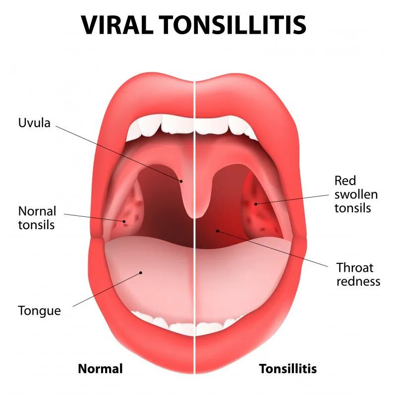 Покажи как выглядит горло What are the Common Causes of Swollen Tonsils? (with pictures)