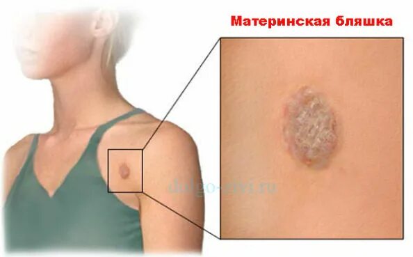 Покажи как выглядит лишай на человеке Герпес на теле: симптомы, причины и лечение кожных высыпаний best-facebook.ru