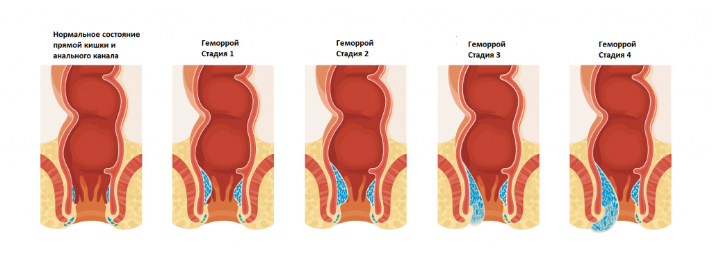 Покажи картинки как выглядит геморрой Геморрой